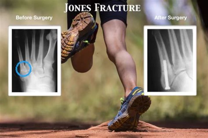 Can you walk on a pseudo Jones fracture?