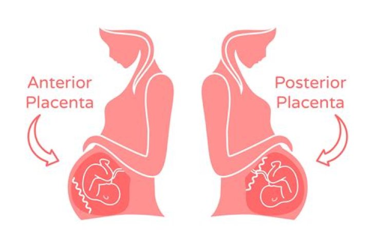 Does anterior placenta affect fetal movement?