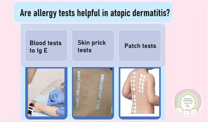 How do they test skin for allergies?