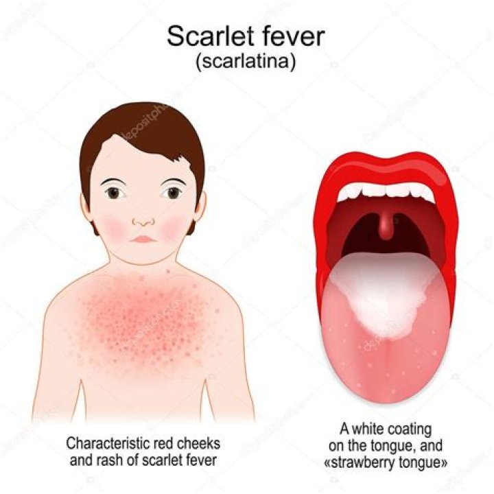 Is there a difference between scarlet fever and scarlatina?