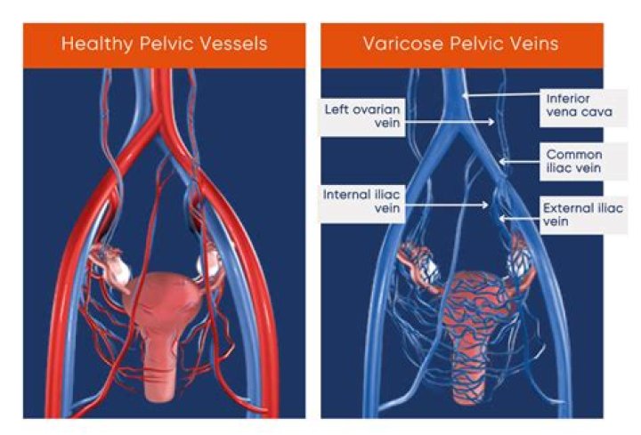 What are pelvic varices?