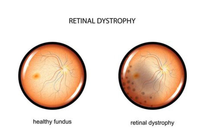 What are retinal dystrophies?