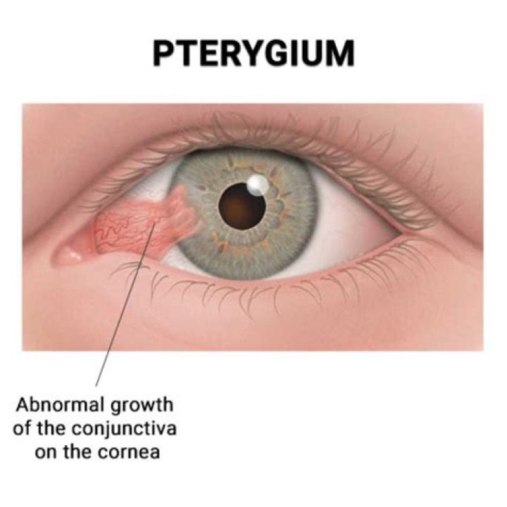 What are the side effects of pterygium surgery?
