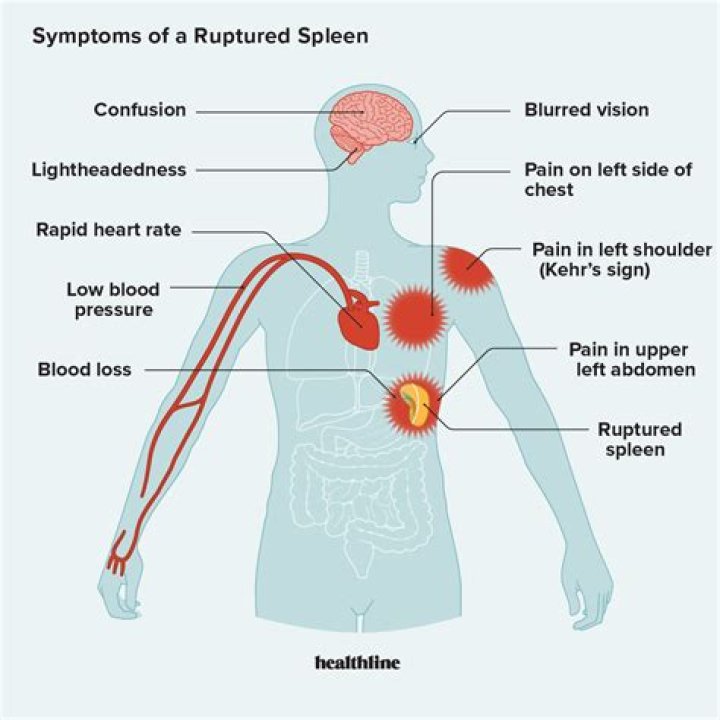 What are the symptoms of splenic artery aneurysm?