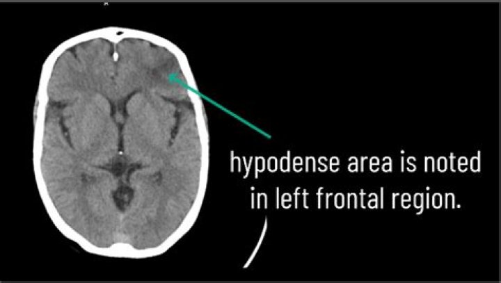 What does hypodense lesion mean?