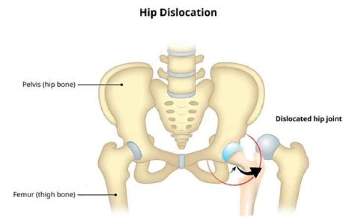 What does it mean to reduce a hip dislocation?