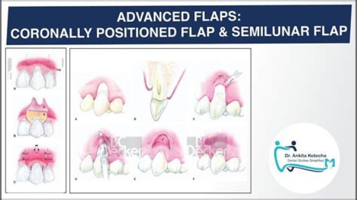 What is Coronally positioned flap?
