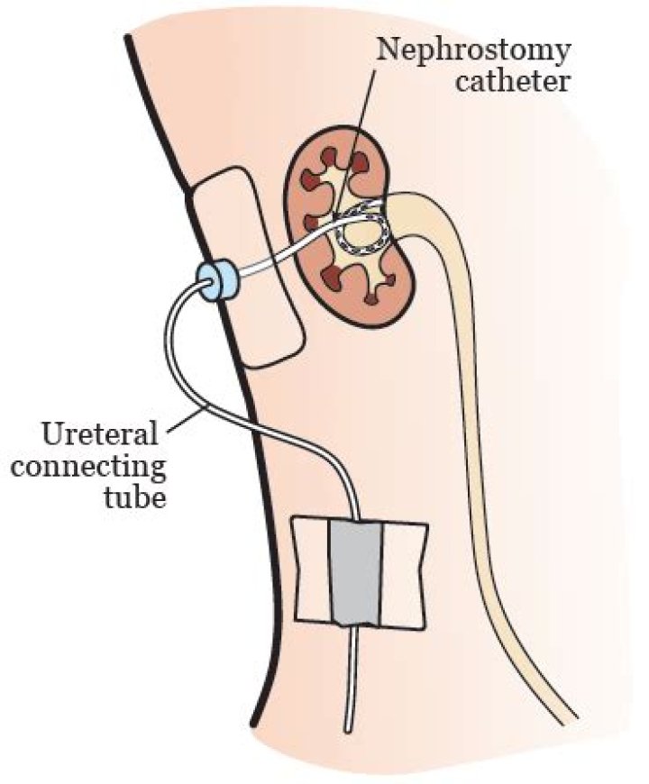 What is the purpose of a percutaneous nephrostomy?