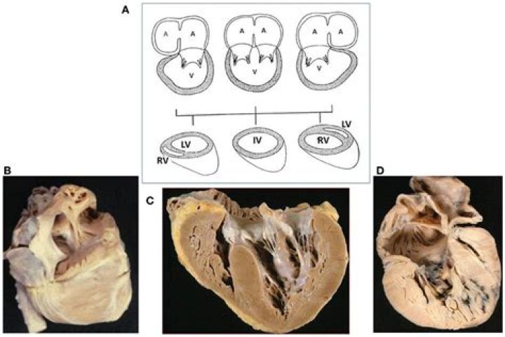 What is Univentricular heart?